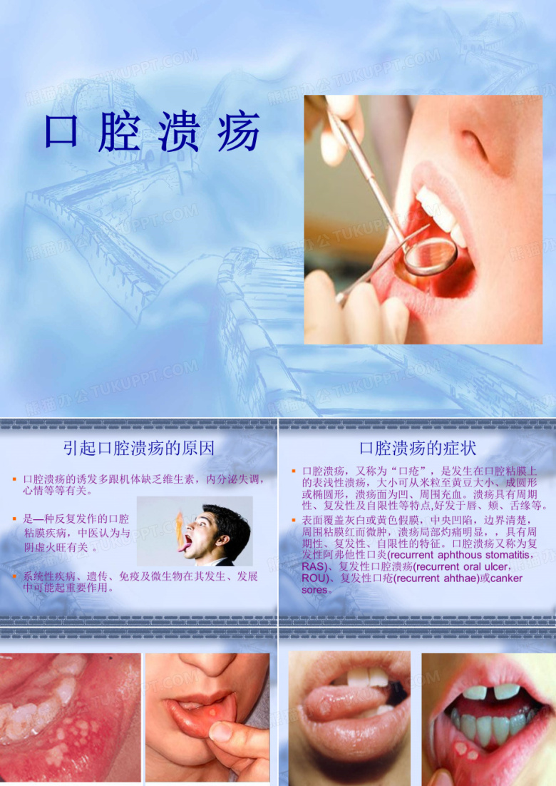 口腔溃疡
