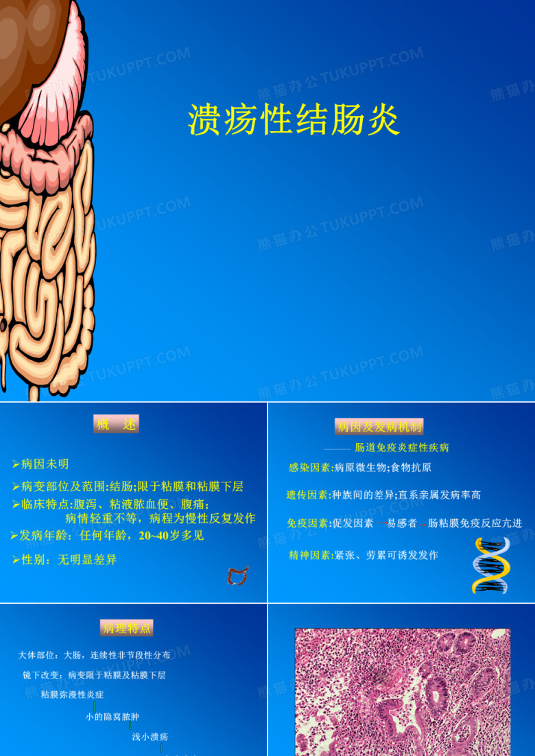 溃疡性结肠炎