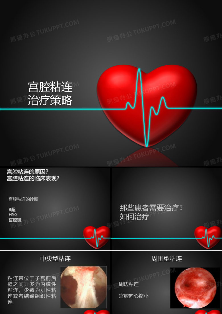 宫腔粘连治疗
